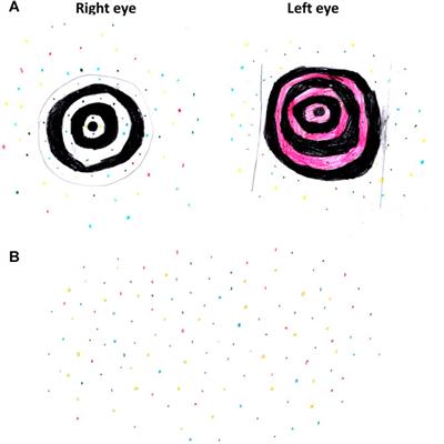 Rare Co-Occurrence of Visual Snow in a Female Carrier With RPGRORF15-Associated Retinal Disorder